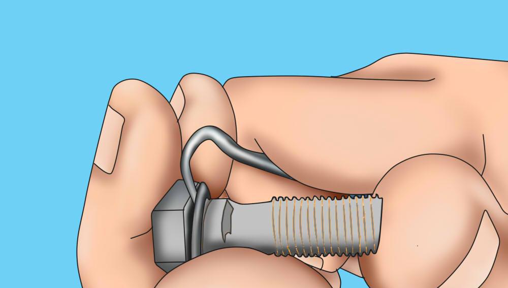 Partie 3 de 4 : Transfert de la conduite de frein vers le nouvel étrier